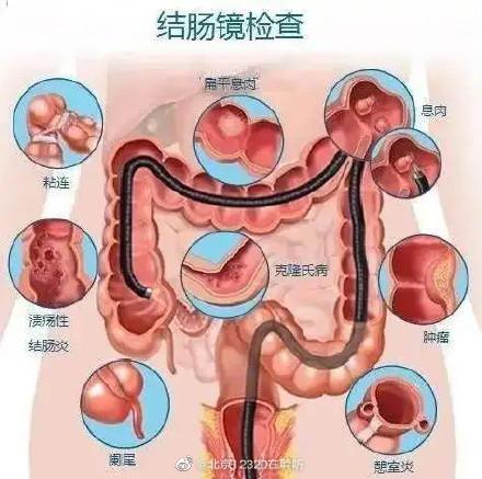 为什么不建议年轻人做肠镜(为什么不建议年轻人做肺部ct)
