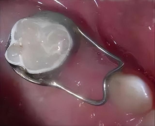 儿童间隙保持器好后悔(儿童间隙保持器什么时候摘除)插图3