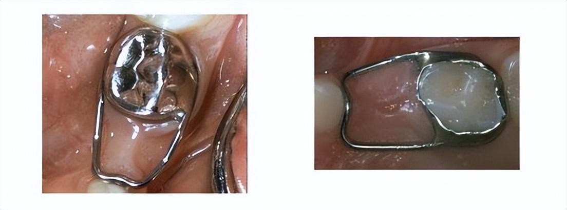 儿童间隙保持器好后悔(儿童间隙保持器什么时候摘除)插图4