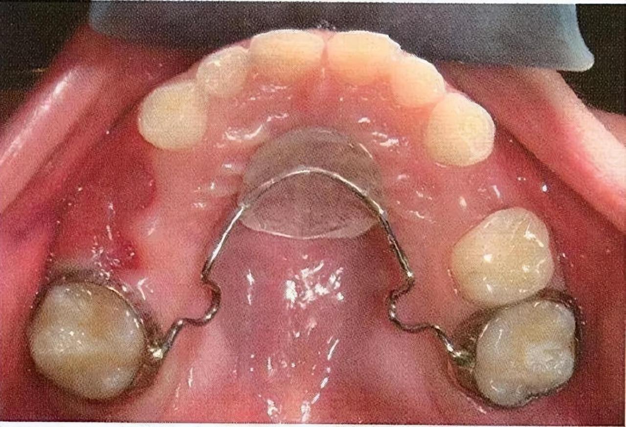 儿童间隙保持器好后悔(儿童间隙保持器什么时候摘除)插图5