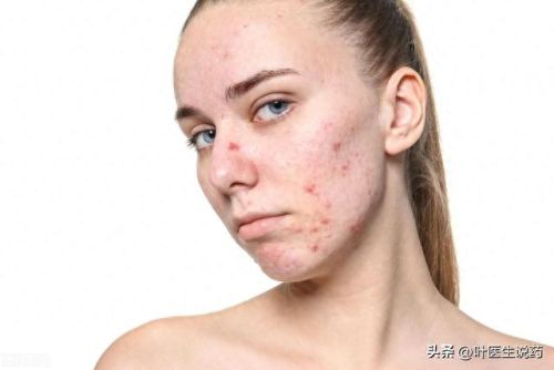 痤疮膏十大排行榜最新(痤疮膏哪些牌药效好)插图