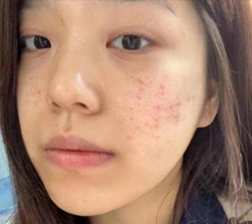 去痘产品十大排行榜(如何祛痘)插图 去痘产品十大排行榜(如何祛痘)插图