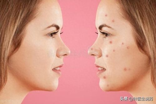 痤疮膏十大排行榜最新(痤疮膏哪些牌药效好)