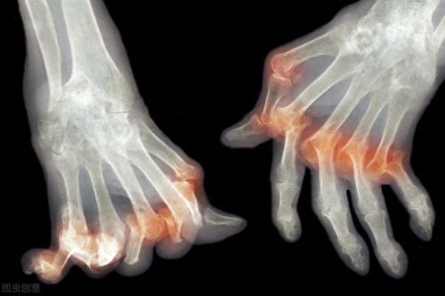 痛风药止痛十大排行榜(痛风饮食禁忌)插图1