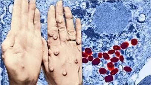 世界上的十大疾病排行榜(中年人常见的十大疾病)插图7 世界上的十大疾病排行榜(中年人常见的十大疾病)插图7