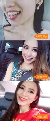 东莞正畸医生排名前十(东莞孙晓玲医生)插图6 东莞正畸医生排名前十(东莞孙晓玲医生)插图6